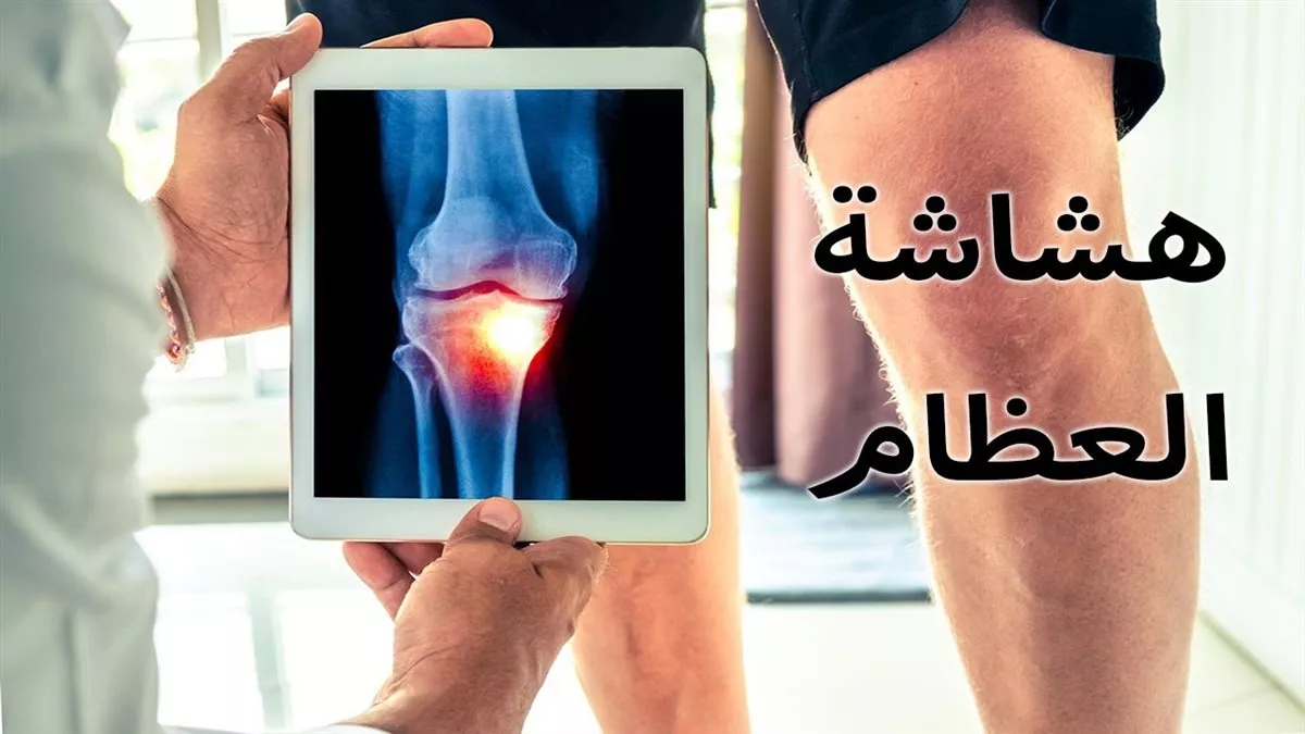 هشاشة العظام